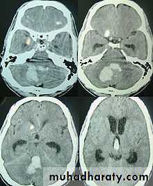 Intracranial hemorrhage
