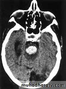 Intracranial hemorrhage