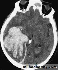 Intracranial hemorrhage