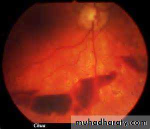 Intracranial hemorrhage