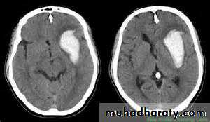 Intracranial hemorrhage