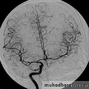 Intracranial hemorrhage