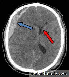 Intracranial hemorrhage