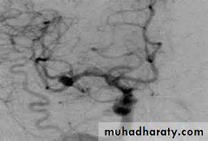 Intracranial hemorrhage