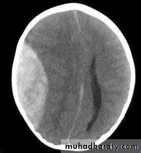 Intracranial hemorrhage
