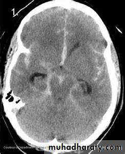 Intracranial hemorrhage