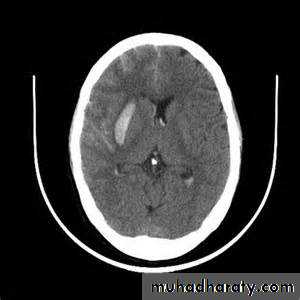 Intracranial hemorrhage