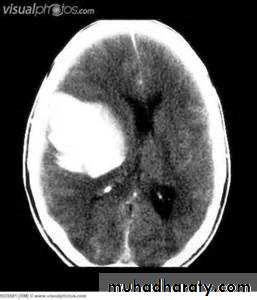 Intracranial hemorrhage