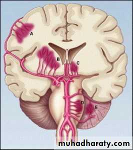 Intracranial hemorrhage