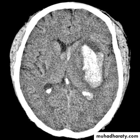 Intracranial hemorrhage