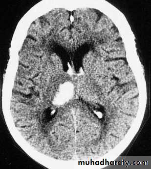 Intracranial hemorrhage