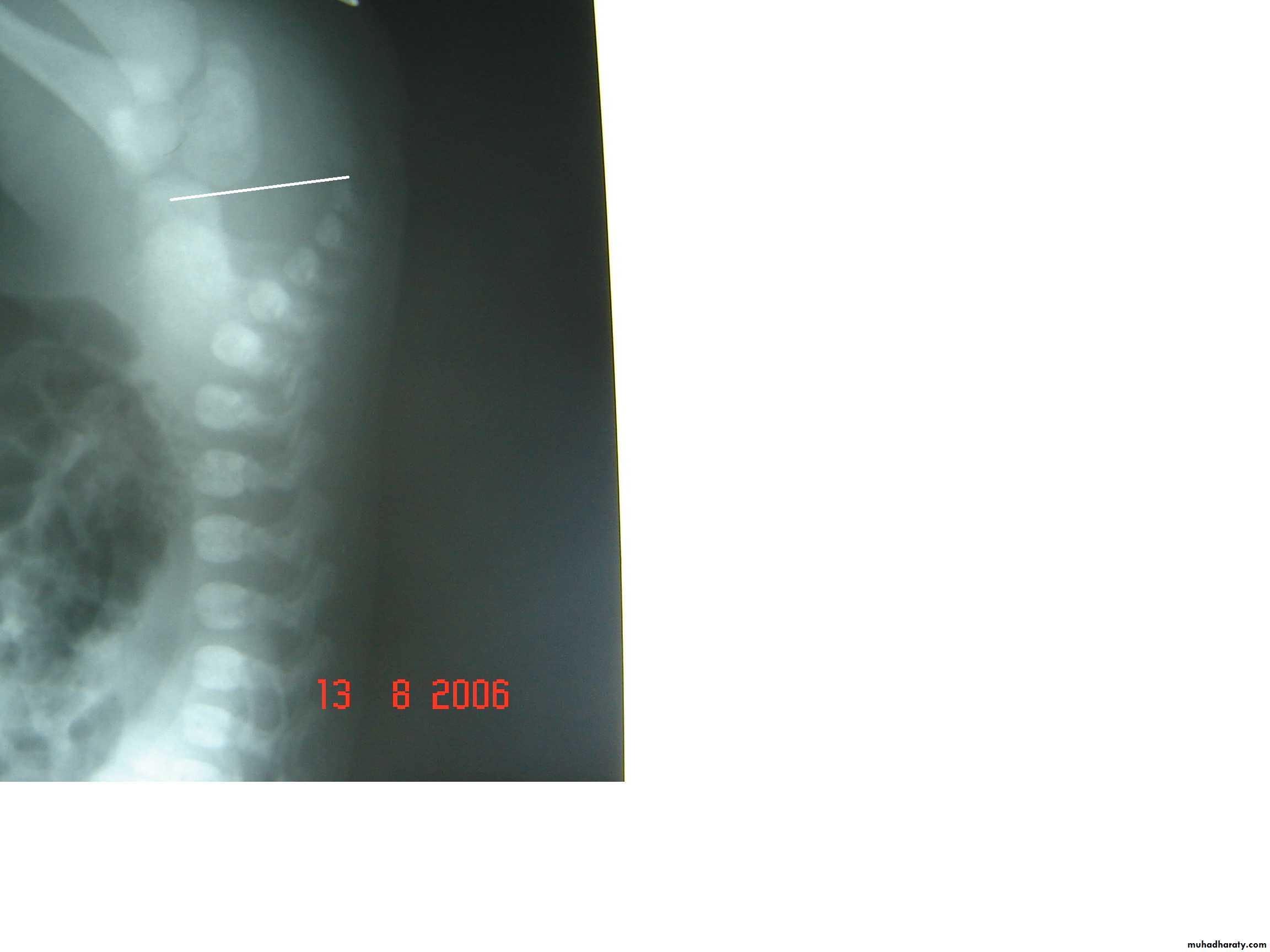 Pediatric surgery