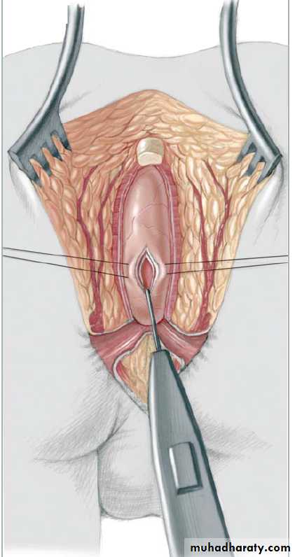 Pediatric surgery