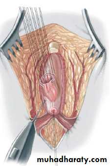 Pediatric surgery