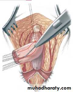 Pediatric surgery