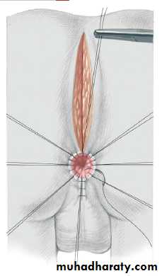 Pediatric surgery