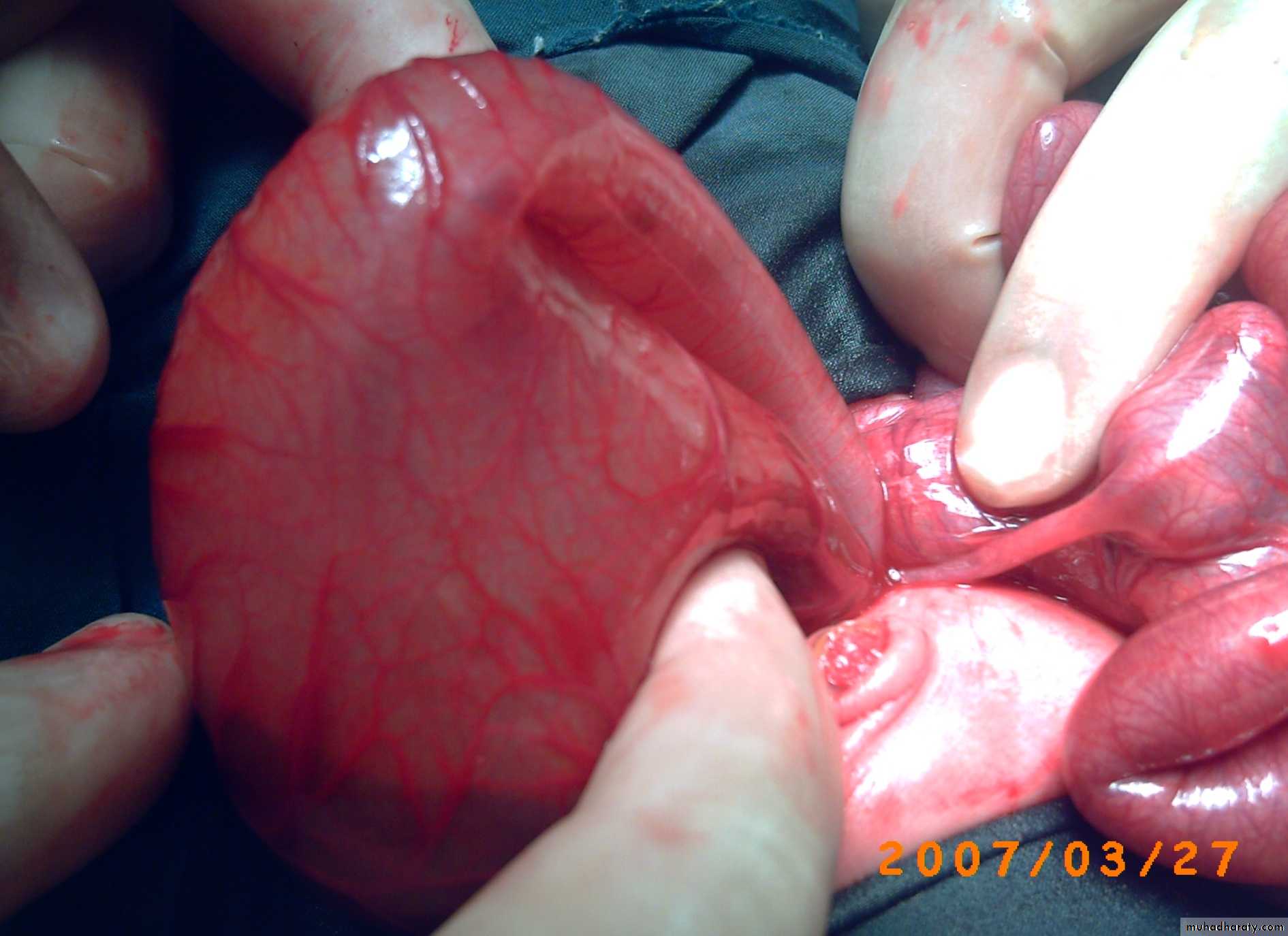 Pediatric surgery