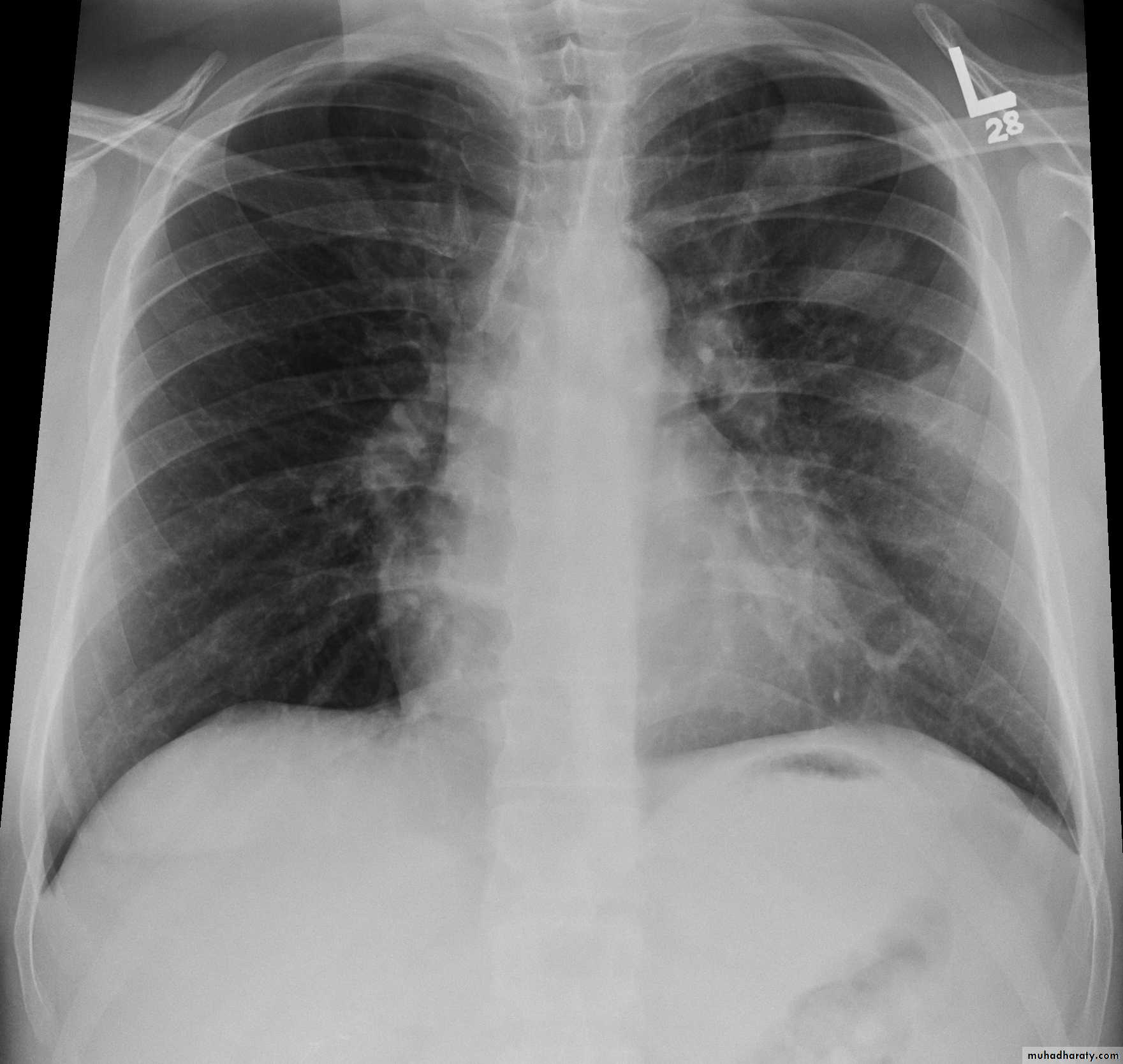 venous disorders
