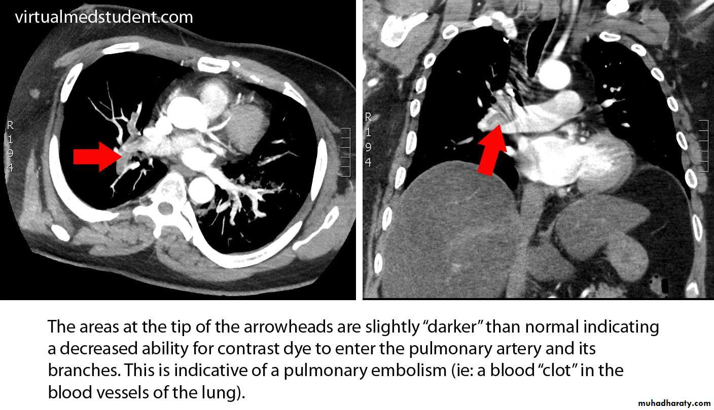 venous disorders