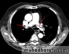 venous disorders