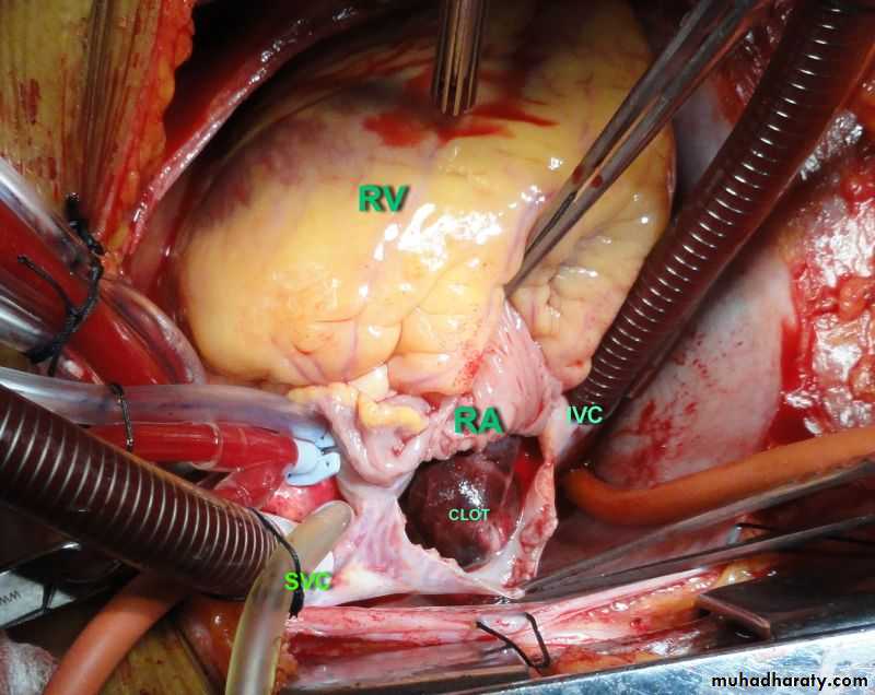 venous disorders
