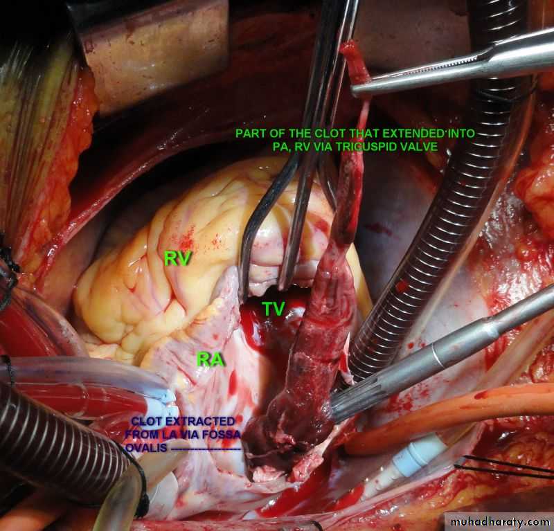 venous disorders