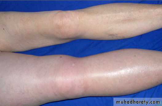 venous disorders