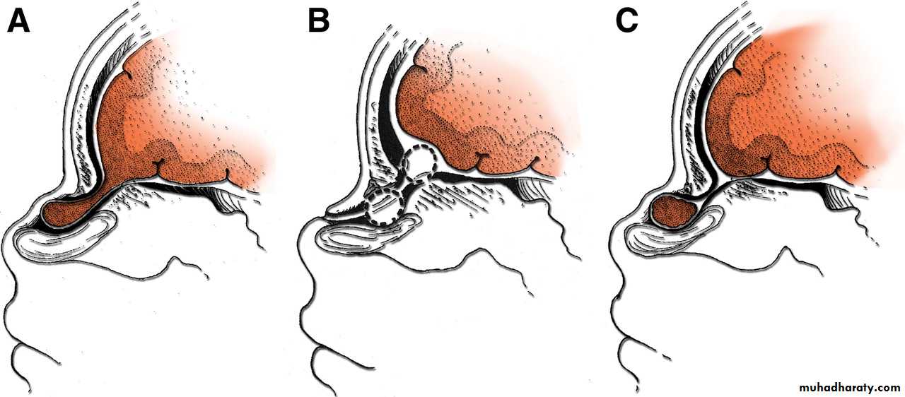 Developmental Abnormalities of the Nervous System