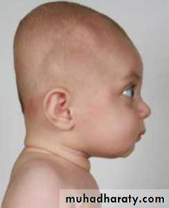 Developmental Abnormalities of the Nervous System