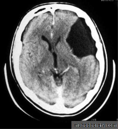Developmental Abnormalities of the Nervous System