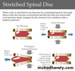 Spine disorders including Disc herniation