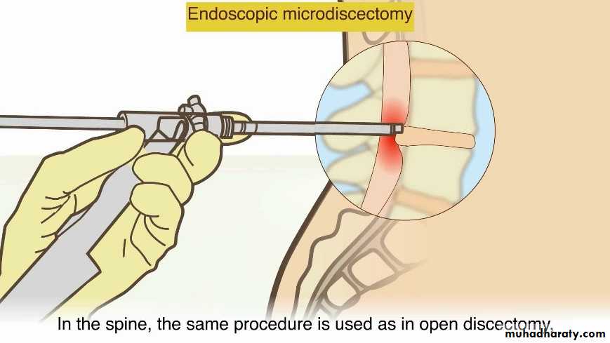 Spine disorders including Disc herniation