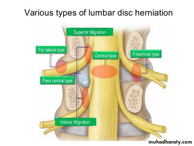 Spine disorders including Disc herniation