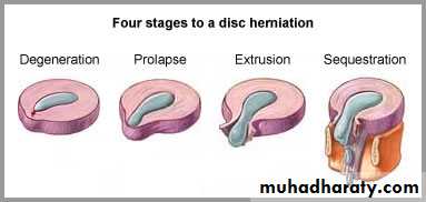 Spine disorders including Disc herniation