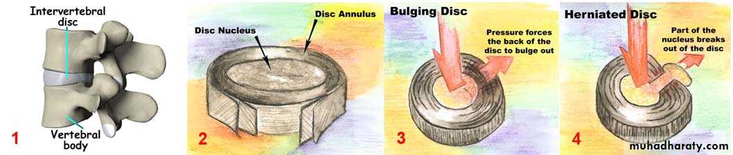 Spine disorders including Disc herniation