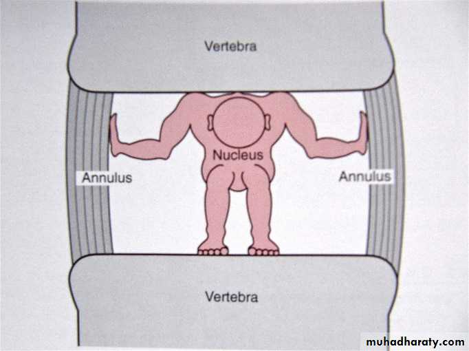 Spine disorders including Disc herniation