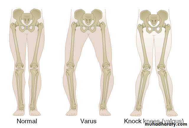 knee disorder