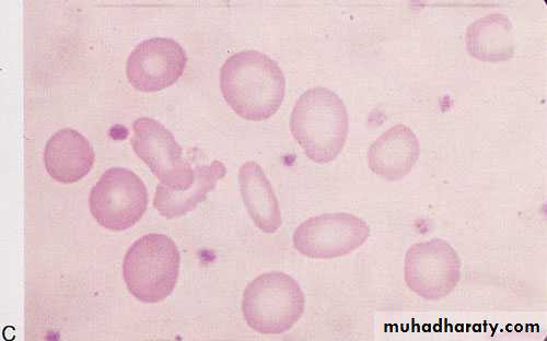 Haematology Anemia