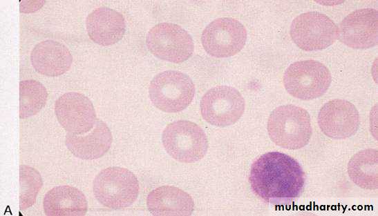 Haematology Anemia