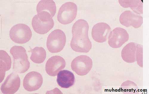 Haematology Anemia
