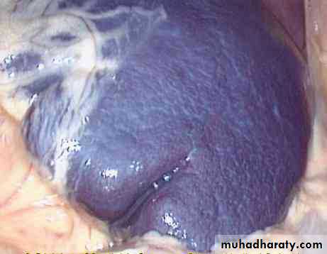 Haematology Anemia