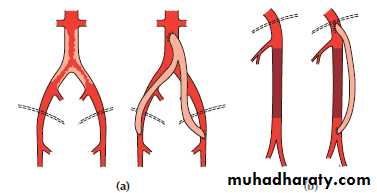 arterial disaeses