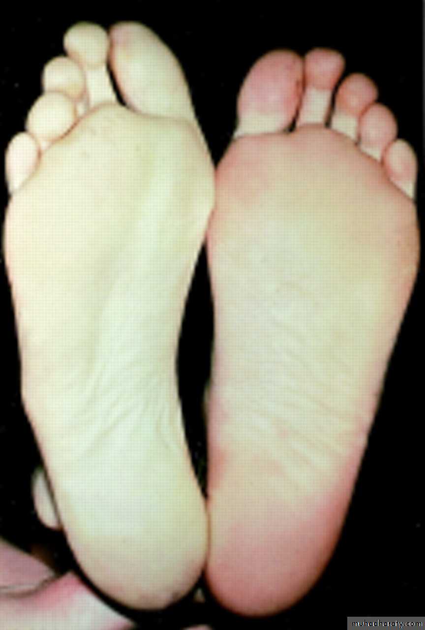 arterial disaeses