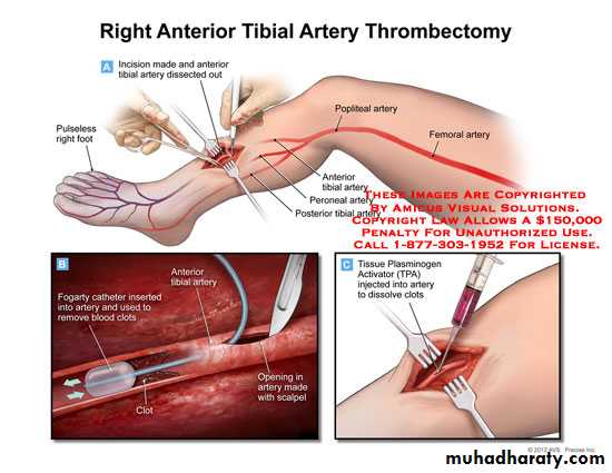 arterial disaeses