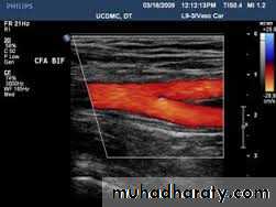 arterial disaeses
