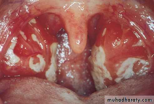 Infectious mononucleosis