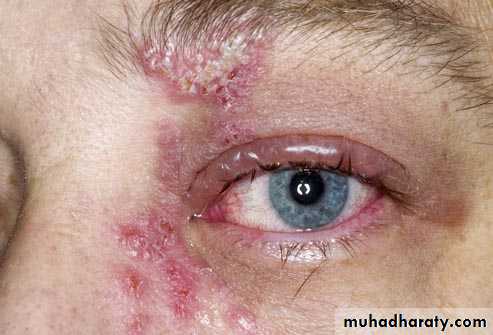 Infectious mononucleosis
