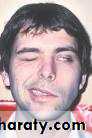 Infectious mononucleosis