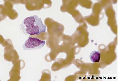 Infectious mononucleosis