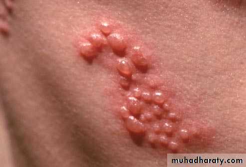 Infectious mononucleosis